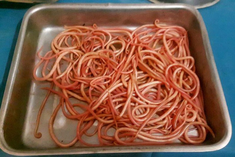 Nhiễm giun đũa - Hình ảnh minh họa